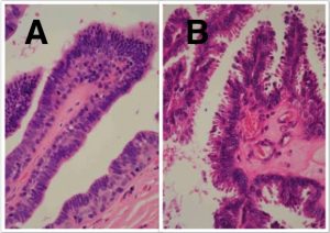 Fig-4-15-Intraduct-papillary-lesions[1]