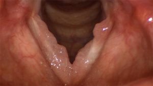 13laryngealpapillomatosis