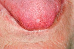 fibroma-on-the-tongue-dr-p-marazziscience-photo-library[1]